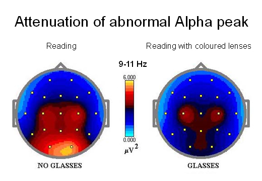 Qeeg Recording